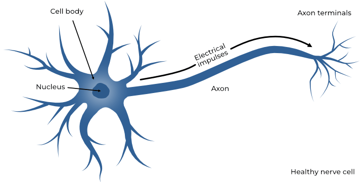 Graphic showing the functioning of a healthy nerve cell (neuron) with electrical impulses passing from the cell body to the axon terminals