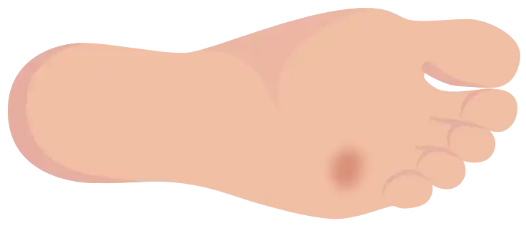 Grade 1 – Superficial ulcer (horizontal foot)