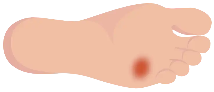 Grade 2 – Deep ulcer (horizontal foot)