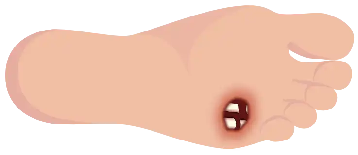 Grade 3 – Ulcer affecting the deeper tissues (horizontal foot)