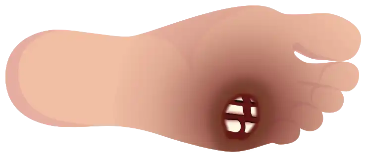 Grade 4 – Partial gangrene of the foot (horizontal foot)