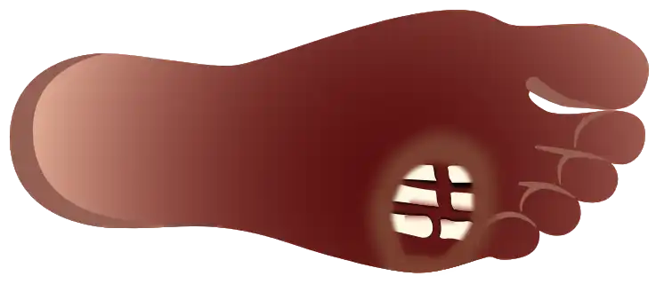 Grade 5 – Gangrene of the whole foot (horizontal foot)