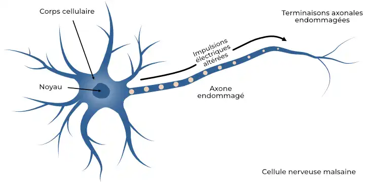 Image d'une cellule nerveuse malade, endommagée par le diabète