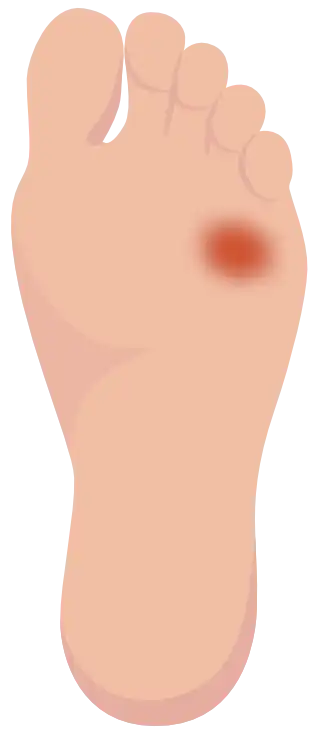 Grade 2 – Deep ulcer (vertical foot)