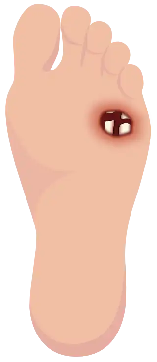 Grade 3 – Ulcer affecting the deeper tissues (vertical foot)