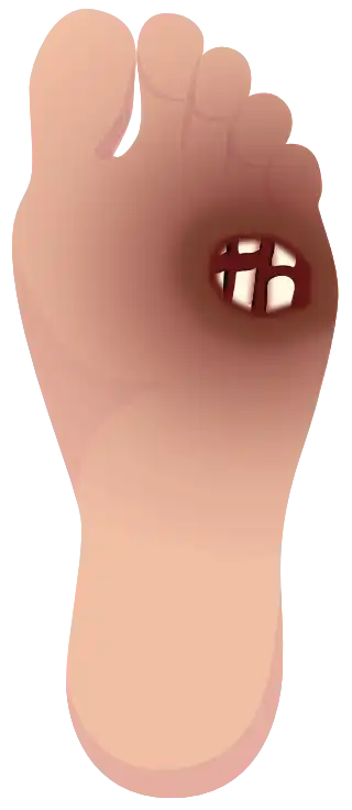 Grade 4 – Partial gangrene of the foot (vertical foot)