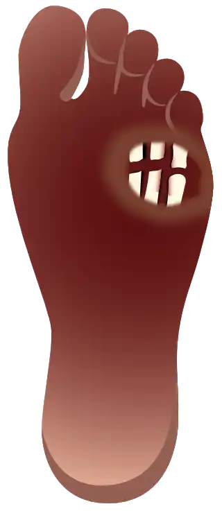 Grade 5 – Gangrene of the whole foot (vertical foot)